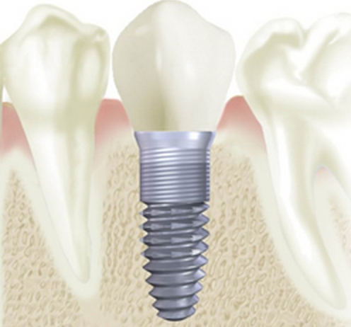 Naples Dental Implant