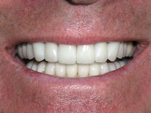 Veneers After Photos