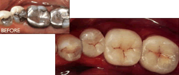 amalgams mercury filling